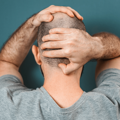Vancouver Scalp Micropigmentation Bald Solution